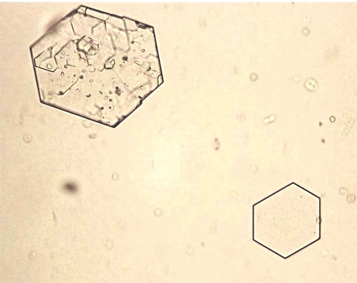 A 16-year-old boy arrives at the emergency department complaining of left-sided abdominal pain and blood in his urine. The intensity of the pain fluctuates and does not improve with rest or position changes. He has had similar pain episodes in the past, but this is the first time he has had gross hematuria. On physical examination, the left costovertebral angle is tender. The urine was examined under a microscope.   Further quantitative laboratory evaluation is most likely to detect which of the following abnormalities in this patient? A) Aminoaciduria B) Hypercalciuria C) Hyperoxaluria D) Hyperuricosuria E) Hypocitraturia
