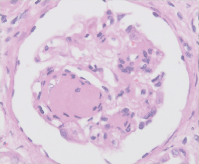 A 61-year-old man comes to the physician because of progressively worsening swelling of his ankles. He says he has felt exhausted lately. Over the past 3 months, he has gained 5 kg (11 lb) . He has smoked one pack of cigarettes daily for 30 years. His pulse is 75/min and his blood pressure is 140/90 mm Hg. Examination shows 2+ pitting edema in the lower extremities. Neurologic examination shows diminished two-point discrimination over the fingers and toes. Laboratory studies show a serum creatinine concentration of 1.9 mg/dL. A urine sample is noted to be foamy. A kidney biopsy is performed; light microscopic findings following staining with hematoxylin and eosin are shown in the image below:   Which of the following is the most likely explanation for this patient's biopsy findings? A) Bee sting with severe allergic reaction B) Diabetes mellitus C) Hepatitis C infection D) HIV infection E) Lung carcinoma F) Recent streptococcal pharyngitis G) Systemic lupus erythematosus H) Treatment with procainamide