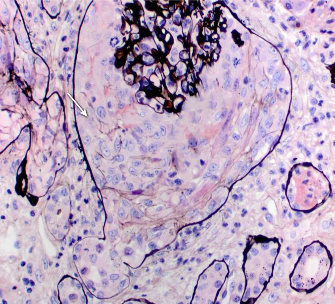 A 25-year-old man is brought to the physician because of fatigue, lethargy, and lower leg swelling for 2 weeks. He also noticed that his urine appeared darker than usual and for the last 2 days he has passed only small amounts of urine. His temperature is 37.5°C (98.6°F) , pulse is 88/min, respirations are 15/min, and blood pressure is 154/98 mm. Blood urea nitrogen is 38 mg/dL and serum creatinine is 4.5 mg/dL.   The patient undergoes a kidney biopsy and the following microscopic changes are seen after silver staining to highlight the glomerular tuft:   The area marked with an arrow is likely to have abnormal deposition of which of the following substances? A) Amyloid B) Fibrin C) IgE D) Lipid E) Myoglobin