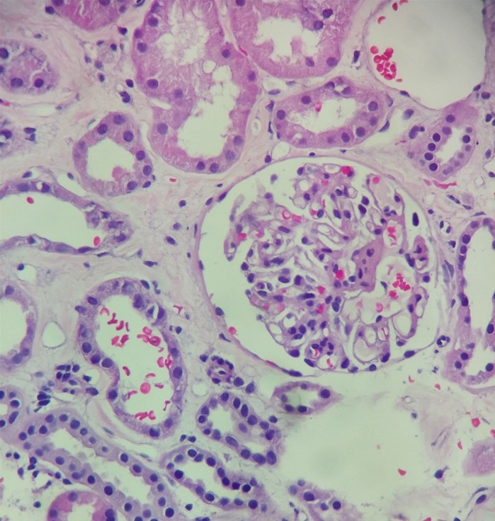 A 15-year-old girl is brought to the clinic for evaluation of swelling around her eyes that developed over the past week.  The patient is a cheerleader, and she had been taking ibuprofen daily for the last 3 months for various sprains and aches after practice.  She has no chronic medical conditions.  Vital signs are normal.  On physical examination, there is moderate periorbital edema with bilateral lower extremity pitting edema.  Serum creatinine is 0.5 mg/dL and serum albumin is 2.1 g/dL.  Urinalysis shows 4+ protein and negative blood.  Multiple regions of the kidney are biopsied, and a representative image is shown below:   Which of the following is the most likely diagnosis? A) Acute interstitial nephritis B) Crescentic glomerulonephritis C) Focal segmental glomerulosclerosis D) Membranous nephropathy E) Minimal change disease F) Poststreptococcal glomerulonephritis