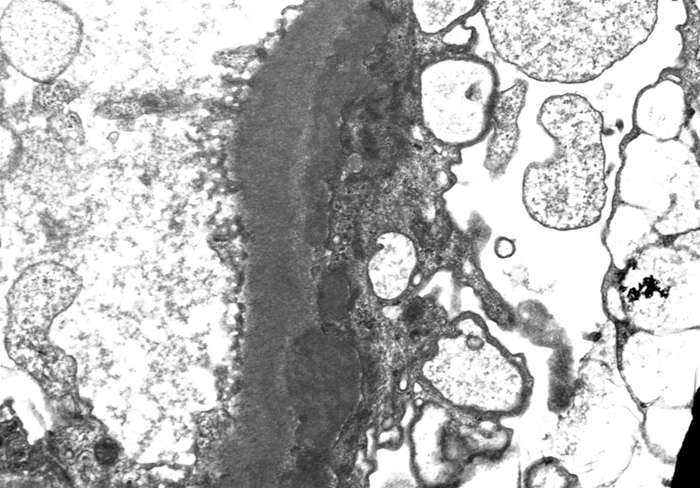 A 42-year-old man comes to the office for evaluation of progressive generalized edema and weight gain for the past several weeks.  He has no chest pain or shortness of breath.  The patient has no chronic medical conditions and takes no medications.  He last saw a physician a year ago for an upper respiratory infection.  The patient does not use tobacco, alcohol, or illicit drugs.  Blood pressure is 130/80 mm Hg and pulse is 84/min.  Mild ascites is present.  There is bilateral lower extremity pitting edema to the knees.Laboratory results are as follows:   Urinary protein excretion is 6.0 g/24 hr.  A kidney biopsy is performed, and electron microscopy of a glomerular capillary is shown below:   Which of the following is the most likely diagnosis? A) Crescentic glomerulonephritis B) Focal segmental glomerulosclerosis C) Membranous nephropathy D) Minimal change disease E) Poststreptococcal glomerulonephritis