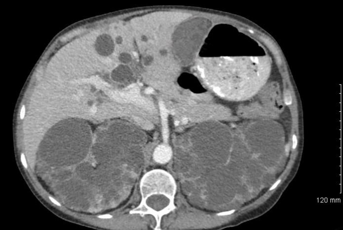 A 54-year-old man comes to the physician due to blood in his urine and abdominal discomfort that occurred 2 days ago.  He was moving potted plants around his porch when he started having pain in his abdomen.  Afterward, he noticed blood in his urine but says it resolved the following day.  He has a history of hypertension.  The patient does not use tobacco, alcohol, or illicit drugs.  Physical examination shows no abnormalities.  CT scan of the abdomen with contrast is shown below.   Which of the following is the most likely diagnosis? A) Glomerulonephritis B) Hydronephrosis C) Nephroblastoma D) Polycystic kidney disease E) Renal cell carcinoma