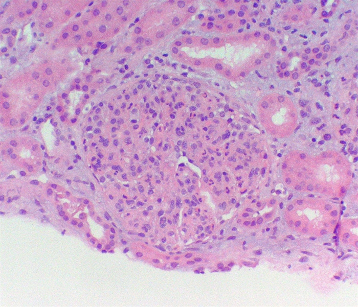 A 12-year-old boy is brought to the clinic because of facial puffiness.  Examination shows periorbital edema.  Urinalysis reveals:   A biopsy image representative of this patient's disease process is shown below.   Which of the following additional findings is most likely to be present in this patient? A) Antiglomerular basement membrane antibodies B) Antineutrophil cytoplasmic antibodies C) Decreased serum C3 level D) Decreased serum C4 level E) Increased eosinophil count