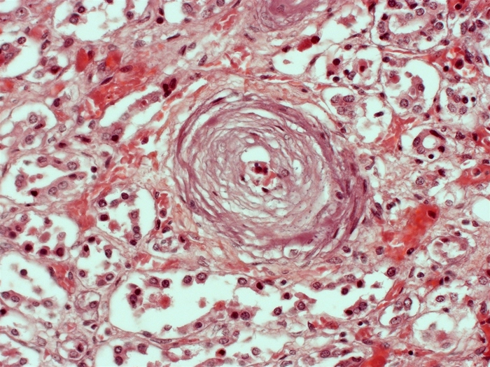 A 55-year-old man is found unresponsive on the street during a cold winter night.  He is hypothermic and does not follow commands.  Medical history is unavailable.  Despite rewarming efforts, the patient dies in the emergency department.  An autopsy is performed.  Light microscopy of a section of the patient's kidney is shown on the slide below.   This individual's renal condition could most likely have been prevented by use of which of the following types of medication? A) Antibiotics B) Antihypertensives C) Antiplatelet agents D) Glucocorticoids E) Hypoglycemic agents F) Nonsteroidal anti-inflammatory drugs