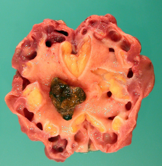 A 54-year-old woman is brought to the hospital due to fever, nausea, vomiting, and confusion.  For the past 3 days, she has had dysuria and increased frequency of urination.  Medical history is significant for recurrent urinary tract infections and primary hypertension.  Family history is insignificant.  Temperature is 39.2 C (102.6 F) , blood pressure is 90/50 mm Hg, pulse is 102/min, and respirations are 24/min.  Examination shows right flank tenderness.  The patient subsequently undergoes nephrectomy, and a cut section of the resected kidney is shown in the image below.   Further evaluation of this patient would most likely reveal which of the following? A) Escherichia coli infection B) High urinary cystine excretion C) Klebsiella infection D) Parathyroid tumor E) Persistently low urine pH