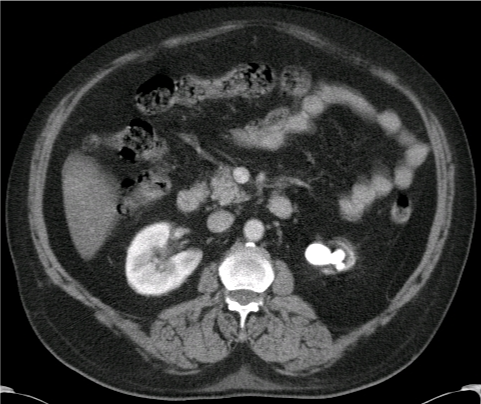 A 60-year-old woman comes to the emergency department due to left flank pain and hematuria.  Medical history is significant for recurrent urinary tract infections and hypothyroidism.  Blood pressure is 130/80 mm Hg and pulse is 80/min.  Physical examination shows left flank tenderness.  CT scan of the abdomen is shown below:   Urinalysis for this patient would most likely show which of the following? A) 4+ protein B) Numerous eosinophils C) pH 8.0 D) Red blood cell casts E) Specific gravity 1.002 F) Uric acid crystals