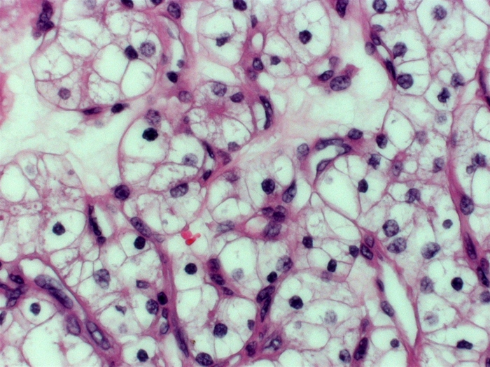 A 63-year-old man comes to the emergency department due to fever and loss of appetite.  He also has chest pain with deep breaths.  The patient has never had regular medical care and his medical history is unknown.  He has smoked half a pack of cigarettes daily for 30 years.  Laboratory evaluation shows a hematocrit of 56%.  Chest imaging shows multiple round lesions in both lungs.  Biopsy of one of the lesions reveals the microscopic findings shown below.   This patient's metastatic disease most likely originated from which of the following organs? A) Bone B) Brain C) Colon D) Kidney E) Stomach F) Testis