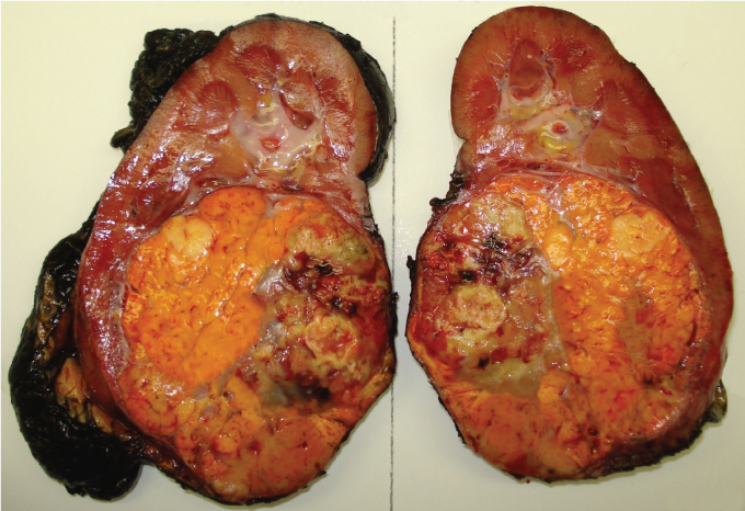 A 50-year-old man comes to the office for evaluation of abdominal fullness and mild right flank pain.  He also reports a weight loss of 4.5 kg (10 lb)  over the past 2 months.  The patient has no other medical issues and works in a local industrial chemical manufacturing facility.  Examination shows a soft abdomen.  Ultrasound reveals a mass in the right kidney.  A subsequent abdominal CT scan confirms the presence of a large right renal mass with evidence of necrosis.  The patient undergoes a right total nephrectomy.  The specimen is shown below.   This patient's lesion most likely originated from which of the following portions of the kidney? A) Blood vessels B) Collecting duct cells C) Glomeruli D) Proximal renal tubules E) Renal pelvis lining