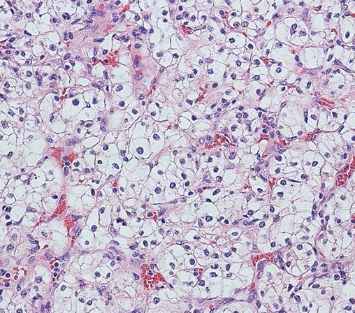 A 65-year-old man comes to the office for evaluation of blood in the urine.  The patient has no abdominal pain, urinary frequency, or urgency.  He has hypertension, type 2 diabetes mellitus, and stage II chronic kidney disease.  He quit smoking 10 years ago and had smoked a pack of cigarettes daily for 30 years.  On examination, vital signs are within normal limits.  The patient's BMI is 33 kg/m<sup>2</sup>.  After appropriate work-up, the patient undergoes a renal biopsy; histopathologic findings are shown below.   Which of the following processes most likely accounts for the abnormal appearance of these cells? A) Glycogen and lipid accumulation B) Karyorrhexis C) Membrane lipid peroxidation D) Mitochondrial swelling E) Pigment accumulation