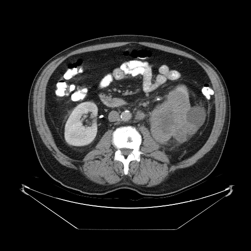 A 64-year-old man comes to the office due to several episodes of intermittent hematuria over the past 2 months.  He has had no abdominal pain, burning on urination, or fever but has lost 4.5 kg (10 lb)  since the onset of symptoms.  The patient has smoked a pack of cigarettes daily for 30 years.  Vital signs are within normal limits.  The abdomen is soft, nontender, and nondistended.  An enlarged and firm prostate is palpated on digital rectal examination.  Serum calcium is 12.3 mg/dL.  Urinalysis shows 30-40 red blood cells/hpf, negative protein, and no casts.  A CT scan of the abdomen is shown below.   Which of the following is the most likely diagnosis? A) Bladder cancer B) Pheochromocytoma C) Polycystic kidney disease D) Prostate cancer E) Renal cell carcinoma F) Ureterolithiasis