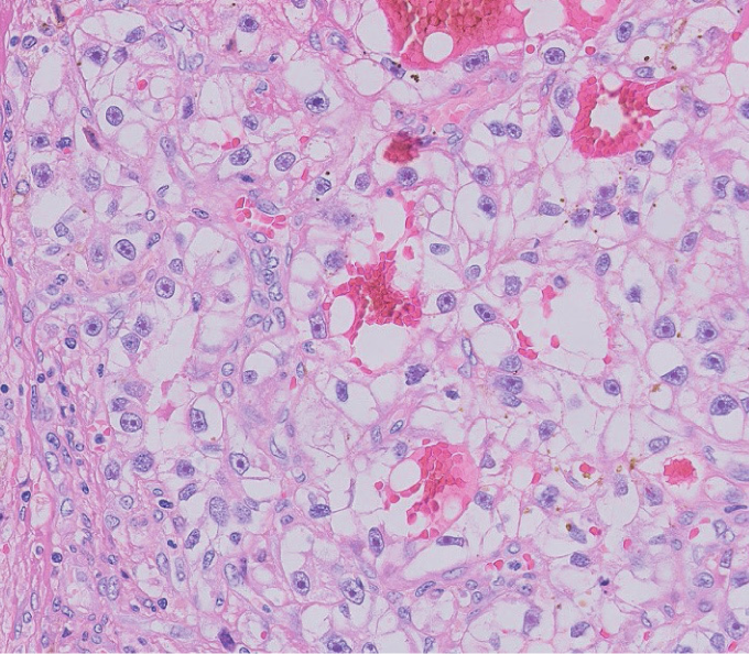 A 68-year-old woman comes to the office due to increasing low back pain.  The pain is constant and worsens at night.  She has also had a 6.8-kg (15-lb)  weight loss over the past 3 months.  Medical history is significant for osteoporosis and hypothyroidism.  Family history is significant for breast cancer in her mother.  She has smoked 1 pack of cigarettes daily for 30 years and drinks 1 or 2 glasses of wine every day.  The patient immigrated to the United States from China 30 years ago; she mainly eats food she cooks herself.  Vital signs are within normal limits.  Physical examination shows point tenderness over the L3 and L4 vertebrae.  MRI reveals lytic bone lesions in the corresponding vertebrae and also a right lower pole kidney mass.  Histologic examination of the mass is shown below:   Which of the following risk factors most likely contributed to this patient's current condition? A) Alcohol use B) Diet C) Ethnicity D) Family history E) Smoking