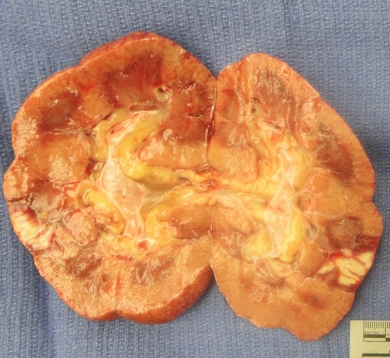 A 54-year-old man comes to the hospital due to acute-onset right flank pain associated with nausea.  Five years ago, the patient had nephrolithiasis; the renal calculi passed spontaneously with intravenous fluids.  Review of systems is positive for occasional palpitations.  Other medical problems include hypertension, obesity, and obstructive sleep apnea.  Temperature is 38 C (100.4 F) , blood pressure is 170/98 mm Hg, pulse is 90/min, and respirations are 18/min.  Cardiopulmonary examination shows no abnormalities.  Right flank tenderness is present.  Urinalysis demonstrates 2+ red blood cells and no white blood cells or protein.  A representative kidney specimen is shown below:   Which of the following is the most likely diagnosis? A) Nephrolithiasis B) Pyelonephritis C) Renal cell carcinoma D) Renal infarction E) Renal papillary necrosis