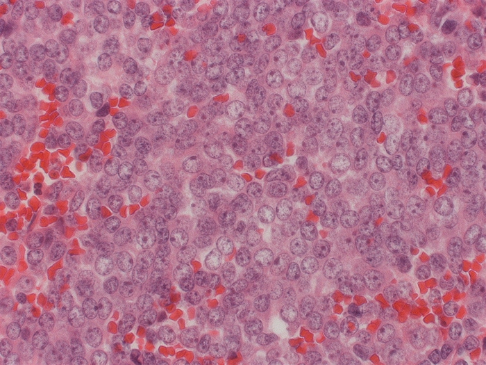 A 15-year-old boy is brought to the emergency department due to hemoptysis.  He has a history of amputation of the right lower extremity for  bone cancer  in Mexico.  Chest imaging reveals a lung mass.  Excisional biopsy of the mass shows sheets of uniform, small (slightly larger than lymphocytes) , round cells with scant, clear cytoplasm.  The cellular deposits are interrupted by vascular fibrous septae, with areas of hemorrhage and an abrupt transition from viable to necrotic cells.  A representative sample is shown in the image.   Which of the following is the most likely diagnosis? A) Adenocarcinoma B) Chondrosarcoma C) Ewing sarcoma D) Multiple myeloma E) Osteosarcoma