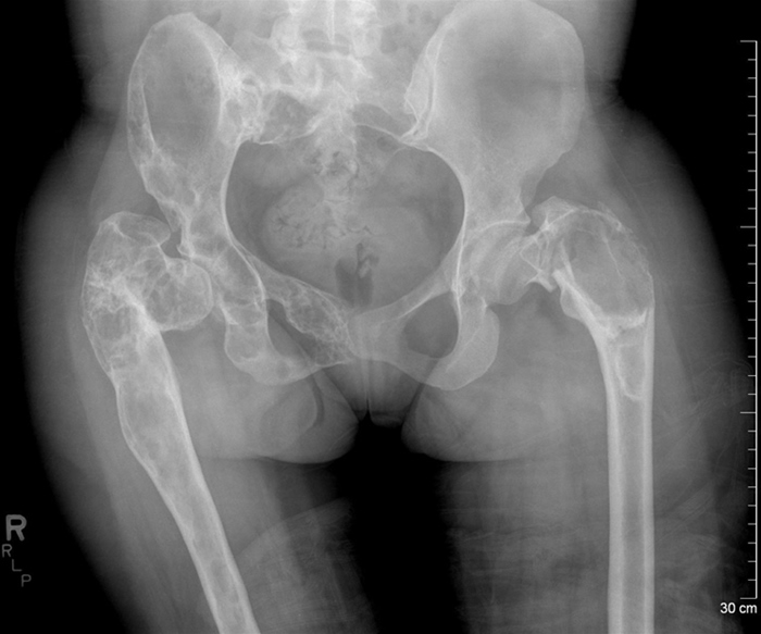 A 29-year-old woman is evaluated for severe left hip pain after twisting her leg.  She has bony deformities of the lower extremities, and her mobility is limited.  The patient has a history of hyperthyroidism, which was managed with radioiodine therapy.  Menarche was at age 7, and she has regular 30-day cycles.  Physical examination shows large, hyperpigmented macules with irregular borders located on the left shoulder, left side of the neck, and left buttock.  X-ray findings are shown in the image below.   Which of the following is the most likely diagnosis? A) Ewing sarcoma B) Gaucher disease C) Legg-Calvé-Perthes disease D) McCune-Albright syndrome E) Neurofibromatosis type 1