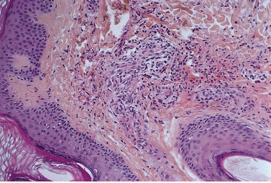 A 17-year-old boy comes to the office due to a skin rash that has been present for a day.  One week ago, he had a sore throat that improved with oral penicillin therapy.  Skin examination shows several violaceous, raised, nonblanchable lesions distributed over the bilateral lower extremities.  Histologic findings of the biopsied rash are shown in the image below.   Which of the following is the most likely diagnosis in this patient? A) Erythema nodosum B) Giant cell vasculitis C) Leukocytoclastic vasculitis D) Polyarteritis nodosa E) Rheumatoid nodules F) Urticaria
