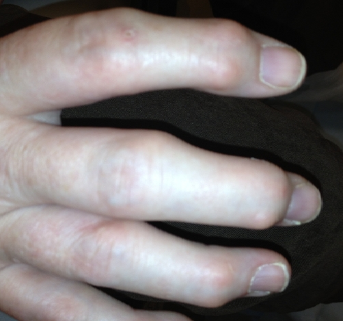 A 52-year-old woman comes to the physician because of a 4-month history of progressive pain and stiffness of the fingers of her right hand that is worse at the end of the day. She works as a hairdresser and has to take frequent breaks to rest her hand. Over the past 2 weeks, she has been taking ibuprofen as needed for the joint pain . She drinks one to two beers daily and occasionally more on weekends. Her vital signs are within normal limits. Physical examination shows firm nodules over the distal interphalangeal joints bilaterally as shown in the image below.   Which of the following is the most likely cause of this patient's symptoms? A) Fibromyalgia B) Gout C) Infectious arthritis D) Osteoarthritis E) Reactive arthritis F) Rheumatoid arthritis