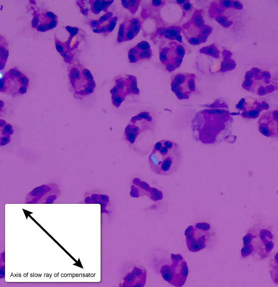 A 57-year-old man comes to the emergency department due to a 1-day history of pain and swelling in his right knee.  The pain is severe, and he has had difficulty bearing weight on the right leg.  He previously felt well.  Past medical history is notable for hypertension and seasonal allergies.  The patient does not use tobacco and drinks 1 or 2 alcoholic beverages a week.  On examination, the right knee is red and swollen.  He has pain with passive range of motion at the knee.  The knee ligaments show no significant laxity.  Synovial fluid obtained from the involved joint shows a white blood cell count of 25,000/mm<sup>3</sup>, with a neutrophilic predominance, and numerous crystals (shown below) .   These crystals are most likely composed of which of the following substances? A) Calcium hydroxyapatite B) Calcium oxalate C) Calcium pyrophosphate D) Cholesterol E) Monosodium urate F) Uric acid