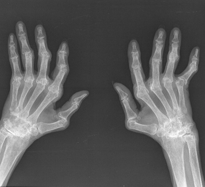 A 61-year-old woman who recently immigrated to the United States has a long history of  joint problems.   She began to have pain in her hands at age 30, and her symptoms have been intermittent but progressive since then.  The symptoms were treated with nonsteroidal anti-inflammatory drugs when the pain was most severe.  The patient also has a history of hypertension and chronic anemia.  She does not smoke cigarettes or use illicit drugs.  Family history is insignificant.  On examination, there is gross deformity of multiple joints in both hands.  X-ray findings are shown in the image below.   The disease process responsible for the radiographic findings would most likely affect which of the following? A) Cervical spine B) Lumbar spine C) Sacroiliac joints D) Thoracic spine
