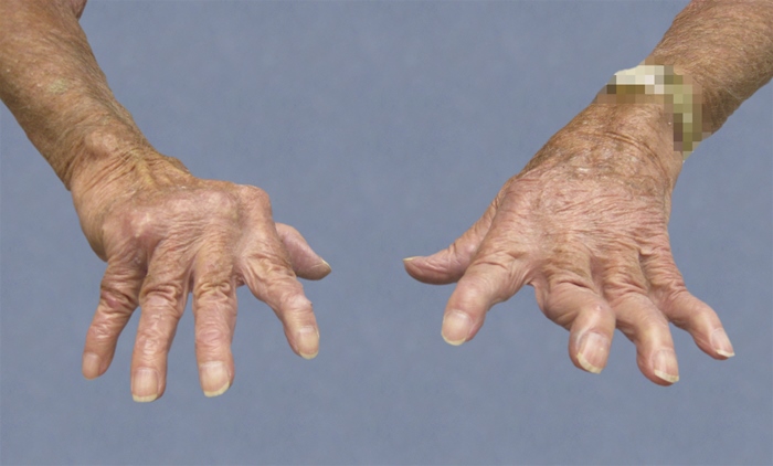 A 68-year-old man comes to the office due to difficulty performing normal day-to-day activities with his hands.  He has had pain in his finger joints, wrists, and knees for many years and has been taking over-the-counter analgesics.  The patient has been evaluated by doctors for  joint problems  in the past but declined their treatment recommendations.  He has smoked a pack of cigarettes daily for 30 years.  Vital signs are normal.  Examination findings of the patient's hands are shown in the image below.   Which of the following pathogenic mechanisms is most likely responsible for this patient's condition? A) Calcific degeneration of the cartilage B) Cartilage thinning and subchondral sclerosis C) DNA/anti-DNA immune complex deposition D) Synovial pannus formation E) Uric acid crystal deposition