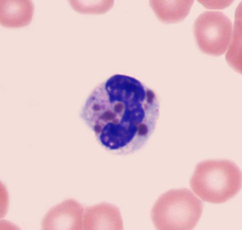 A 2-year-old boy is brought to the clinic due to recurrent infections.  Over the last year, the patient has had multiple skin and pulmonary infections requiring antibiotic therapy.  Temperature is 37.2 C (99 F) , pulse is 120/min, and respirations are 20/min.  The patient has silvery hair.  Eye examination shows horizontal nystagmus.  The oropharynx is clear, and the neck is supple.  Cardiopulmonary examination is unremarkable, and the abdomen is soft.  The skin appears pale with scarring from previous infections.  Peripheral blood smear is shown in the image below:   This patient most likely has which of the following disorders? A) Ataxia telangiectasia B) Chédiak-Higashi syndrome C) Chronic granulomatous disease D) Gaucher disease E) Leukocyte adhesion deficiency F) Wiskott-Aldrich syndrome