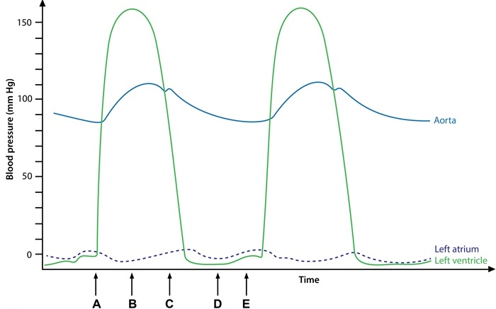 A 73-year-old man is evaluated for exertional dyspnea.  His exercise tolerance has decreased over the last year, and he can barely walk 2-3 blocks without stopping.  The patient also reports occasional episodes of lightheadedness and palpitations.  He has had no chest pain or syncope.  He was diagnosed with hypertension in the past but does not take any medications.  Physical examination reveals a cardiac murmur.  The patient is referred to a cardiologist for further evaluation.  Cardiac catheterization is performed, and the findings are shown in the image below.  Which of the following points most likely corresponds to the peak murmur intensity in this patient?   A) A B) B C) C D) D E) E