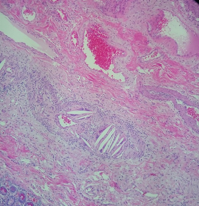 A 72-year-old man comes to the emergency department due to sudden-onset, severe abdominal pain accompanied by nausea.  He has a history of coronary artery disease and recently underwent cardiac angiography.  The patient is a current smoker with a 30-pack-year history.  After initial evaluation, he undergoes emergency laparotomy.  A segment of small intestine is resected.  On microscopic examination, there are several large-caliber vessels with needle-shaped cholesterol clefts in their lumens, as shown in the image below.   Given these findings, the patient is at highest risk for which of the following complications? A) Kidney injury B) Myelosuppression C) Nephrolithiasis D) Pulmonary infarction E) Septic arthritis