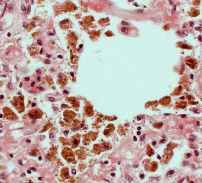 <strong>A 75-year-old man is found unresponsive in his home.  Emergency medical services are called by the neighbor, but the patient is pronounced dead at the scene.  The patient had a history of hypertension, type 2 diabetes mellitus, and coronary artery disease, as well as a 25-pack-year smoking history.  He worked at a coal mine in the remote past and retired as an auto mechanic 15 years ago.  Autopsy is performed; a section of lung tissue stained with hematoxylin and eosin is shown below.   Which of the following is the most likely cause of this patient's abnormal histopathology findings?</strong> A)Chronic inflammation triggered by crystalline silica B)Decreased left ventricular systolic function C)Excessive deposition of extracellular collagen D)Hyperreactivity of airways to extrinsic allergens E)Malignant transformation of bronchial epithelial cells F)Neutrophil elastase-mediated alveolar septal destruction <div style=padding-top: 35px> 