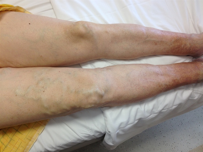 <strong>A 53-year-old woman comes to the office due to aching pain in her legs.  She is a hair stylist and has cut down on her work hours due to the discomfort.  The patient has a history of migraine and untreated chronic hepatitis C.  She smokes a pack of cigarettes daily but does not use alcohol or illicit drugs.  Physical examination findings are shown in the image below.   An abnormality of which of the following is the most likely cause of this patient's symptoms?</strong> A)Arterial intima B)Capillary permeability C)Lymphoid capillaries D)Plasma oncotic pressure E)Vasa vasorum F)Venous valves <div style=padding-top: 35px> 