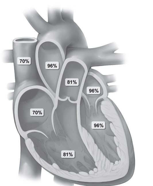 <strong>Cardiac catheterization is performed on a 7-year-old boy.  The image below shows the pattern of oxygen saturation in the patient's cardiac chambers and outflow tracts (structural abnormalities are not shown).   This patient most likely has which of the following findings on physical examination?</strong> A)Bifid carotid pulse with brisk upstroke B)Continuous murmur over the upper precordium C)Decreased femoral-to-brachial blood pressure ratio D)Fixed splitting of S2 on cardiac auscultation E)Holosystolic murmur over the left sternal border F)Mucosal cyanosis and fingernail clubbing <div style=padding-top: 35px> 