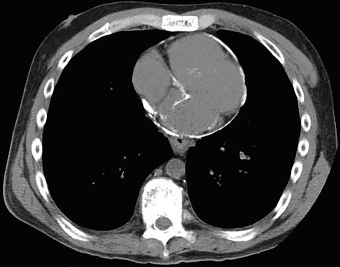 The patient is admitted to the hospital for further workup and treatment.  After initial evaluation, a CT scan of the chest is obtained, an image of which is shown on the slide below.   Which of the following is the most likely diagnosis? A)Aortic dissection B)Constrictive pericarditis C)Hypertrophic cardiomyopathy D)Ischemic heart disease E)Viral myocarditis<div style=padding-top: 35px> 