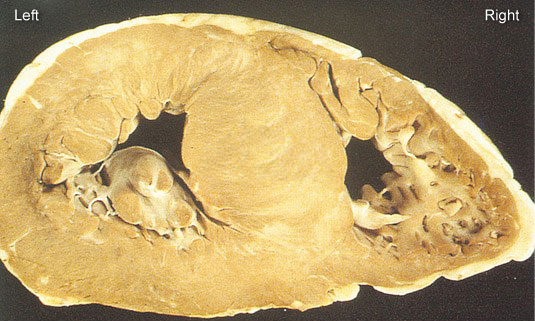<strong>A 25-year-old man with an insignificant medical history was playing soccer when he suddenly collapsed.  Despite all attempts to save his life, he died.  Autopsy is performed.  Gross examination of the heart reveals a weight of 580 g (normal: <350).  The cut surface of the heart is shown in the image.   If this patient had a preparticipation sports screening, cardiac auscultation would have likely revealed a murmur that increases in intensity after which of the following?</strong> A)Passive leg raising B)Phenylephrine infusion C)Squatting D)Sudden standing E)Sustained hand grip <div style=padding-top: 35px> 