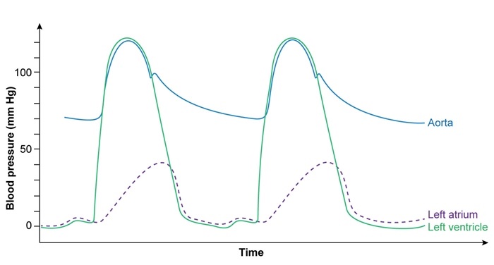 <strong>A 54-year-old woman comes to the office due to exertional dyspnea and fatigue.  The patient gets short of breath while walking to a store 2 blocks away from her home.  She also has trouble breathing at night and sleeps with 2 or 3 pillows to prop her up.  She has had occasional palpitations but no chest pain.  The patient takes no medications on a regular basis, and does not use tobacco, alcohol, or illicit drugs.  After initial evaluation, she is scheduled for a left heart catheterization, the findings of which are shown below.   Which of the following is the most likely diagnosis?</strong> A)Aortic regurgitation B)Aortic stenosis C)Mitral regurgitation D)Mitral stenosis E)Tricuspid regurgitation <div style=padding-top: 35px> 