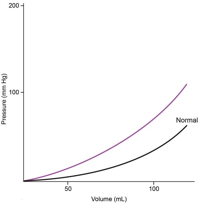 A 72-year-old man is hospitalized due to fatigue, orthopnea, and exertional dyspnea.  The patient takes no medications and has not seen a physician in many years.  He is a lifelong nonsmoker.  His blood pressure is 110/60 mm Hg and pulse is 64/min.  Examination reveals bibasilar crackles, elevated jugular venous pressure, and bilateral lower extremity pitting edema.  His left ventricular end-diastolic pressure-volume is shown in the graph below (purple curve) .   Which of the following is the most likely cause of this patient's condition? A) Alcohol-induced cardiomyopathy B) High-dose doxorubicin therapy C) Selenium deficiency D) Transthyretin deposition E) Viral myocarditis