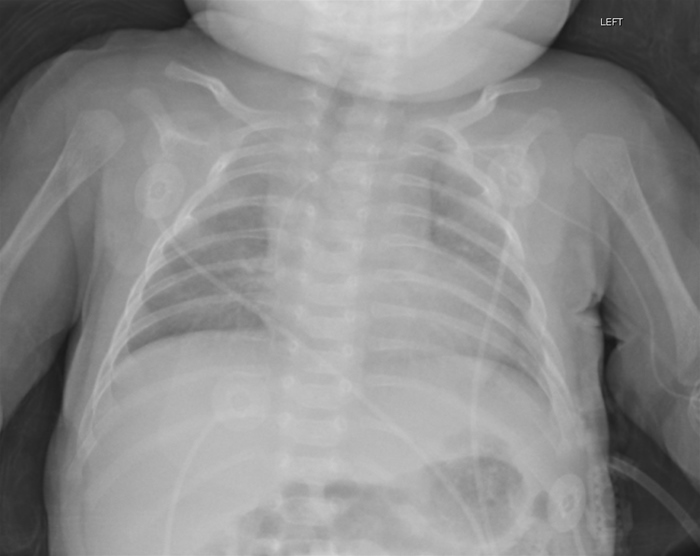 Due to difficulty breathing and sweating with feeds, a 10-day-old boy born at home is brought to the emergency department. He was born via spontaneous vaginal delivery at 38 weeks gestation. The patient has been breastfeeding for 5-10 minutes per side every 2 hours. His mother notices that he sweats while feeding and that his lips turn blue. Weight is in the fifth percentile, and length is in the fifty-fifth percentile. The patient is not currently cyanotic, according to the examination. A III/VI systolic crescendo-decrescendo murmur can be heard along the left upper sternum. The x-ray of the chest is shown below. :   Which of the following most likely represents the pressure changes that take place in this patient during feedings?   A) A B) B C) C D) D
