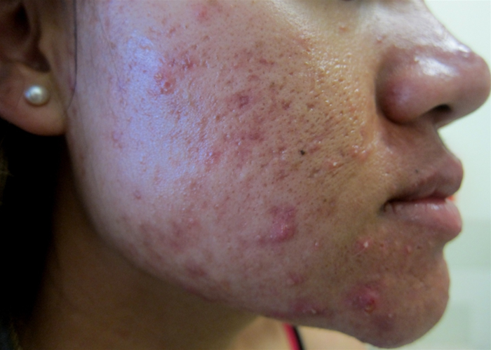 A 22-year-old woman comes to the office due to several years of persistent facial blemishing that has failed to respond to over-the-counter treatment.  The patient has no other medical conditions.  She does not use tobacco, alcohol, or illicit drugs.  Skin examination findings are shown in the image below:   Which of the following most likely contributed to the pathogenesis of this patient's skin condition? A) Androgen-induced involution of sebaceous glands B) Bacterial degradation of apocrine gland secretions C) Estrogen-stimulated secretory function of sebaceous glands D) Increased desquamation of follicular epithelial cells E) Proliferation of lipid-utilizing bacteria within pilosebaceous follicles