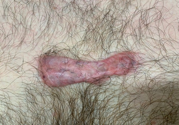 A 23-year-old man comes to the office due to a painful, growing lesion on his chest.  The patient reports a laceration injury to the chest 6 months ago.  A pink, firm plaque on examination is shown in the image below:   Which of the following is most likely responsible for this patient's lesion? A) Decreased insulin-like growth factor-1 signaling B) Decreased PDGF receptor activation on fibroblasts C) Increased fibroblast apoptosis rate D) Overexpression of transforming growth factor beta E) Overproduction of matrix metalloproteinases
