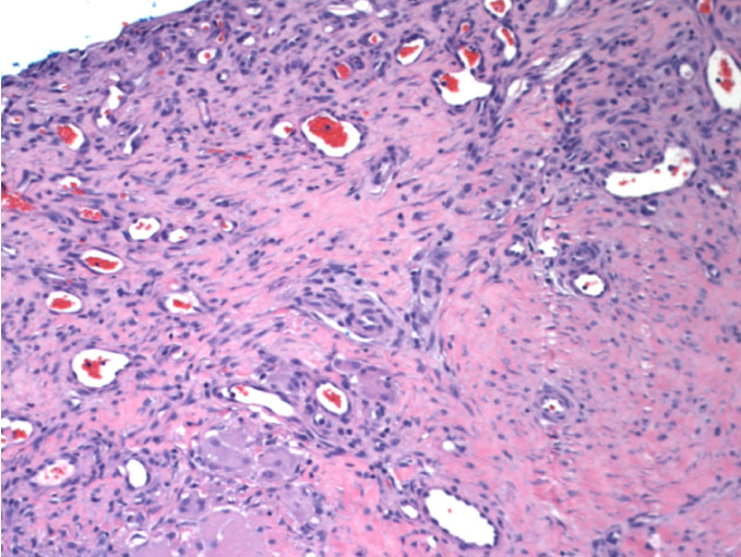 A 72-year-old man is evaluated due to a scaly lesion behind his right ear.  A diagnosis of squamous cell carcinoma is confirmed on biopsy, and the patient undergoes excision of the lesion with clear margins.  The wound is left to heal by secondary intention.  Three weeks later, the patient returns to the office with a 2.5-cm raised, soft, granular lesion at the excision site.  Biopsy of a representative lesion is shown in the image below:   Which of the following is most likely responsible for this patient's postoperative changes? A) Deposition of immunoglobulin-derived fibrils B) Excess production of type I collagen C) Proliferation of dysplastic keratinocytes D) Recruitment and degranulation of neutrophils E) VEGF-induced tissue proliferation