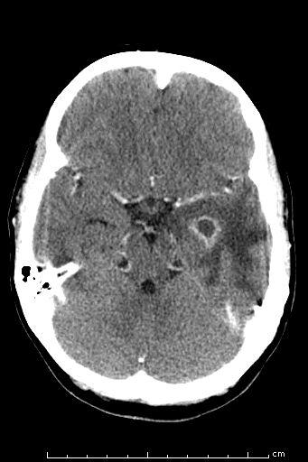 A 5-year-old girl is brought to the emergency department after having a seizure at home.  Approximately an hour ago, the patient collapsed at the dinner table and developed full body shaking and urinary incontinence.  Her mother says that the girl has had a mild headache and fatigue for the past few days.  On examination, the patient is sleepy and difficult to rouse.  Vital signs are normal.  Cardiopulmonary examination is unremarkable.  CT scan of the head is shown in the image below:   Which of the following historical details is most relevant in establishing this patient's diagnosis? A) Family history of seizures B) History of diarrheal illness C) Maternal history of perinatal infection D) Previous recurrent gingival bleeding E) Recent episode of otitis media