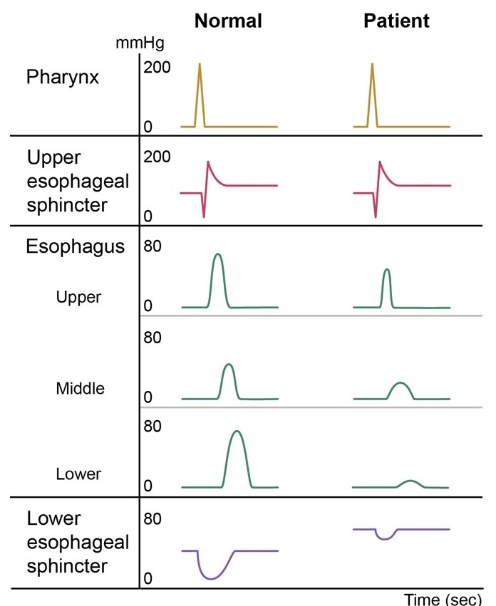 A 43-year-old man is evaluated for retrosternal discomfort and dysphagia for the past several months.  He smokes a pack of cigarettes daily and drinks alcohol on weekends.  His BMI is 32.8 kg/m<sup>2</sup>.  Physical examination is unremarkable.  Esophageal manometry is performed; after a single swallow of 5 mL of water, the tracings appear as shown in the image below.   Which of the following is the most likely diagnosis in this patient? A) Achalasia B) Cricopharyngeal dysfunction C) Diffuse esophageal spasm D) Esophageal stricture E) Systemic sclerosis