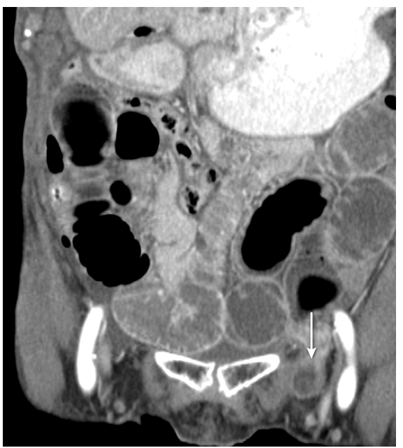 A 64-year-old woman comes to the emergency department due to a 2-day history of worsening abdominal pain.  She has a history of gallstones but has had no surgery due to high operative risk.  Medical history includes chronic obstructive pulmonary disease, hypertension, and remote cervical cancer treated with surgery and chemotherapy.  Abdominal CT scan shows multiple dilated small bowel loops with a decompressed distal ileum, and an abnormal bowel indicated by the arrow shown below:   Which of the following is the most likely cause of this patient's current condition? A) Gallstone ileus B) Incarcerated hernia C) Intestinal malrotation D) Intestinal volvulus E) Peritoneal adhesion