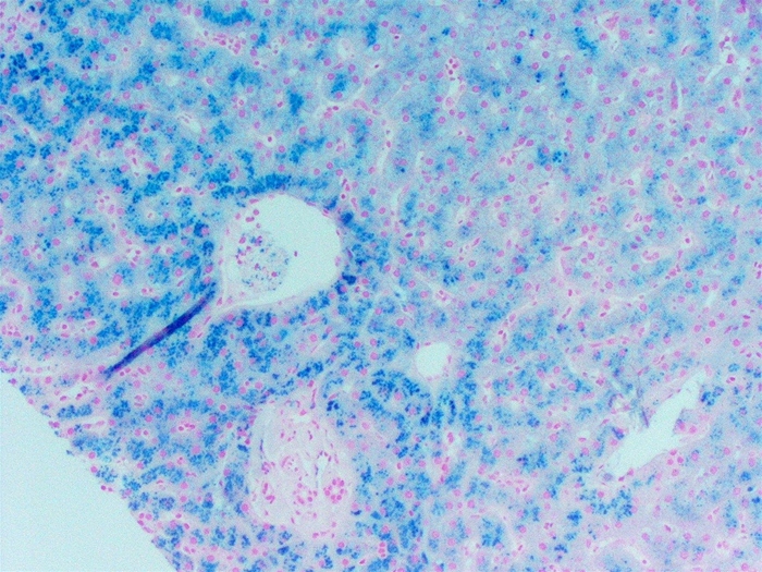 A 63-year-old woman dies of congestive heart failure.  Autopsy shows a dilated heart with brownish pigmentation of the myocardium.  Light microscopy of her liver after Prussian blue staining is shown in the image below:   The patient's brother died of profuse upper gastrointestinal bleeding at age 43.  Assuming this patient's disorder is hereditary, which of the following most likely contributed to the delayed onset of her disease compared to her brother? A) Heterozygosity for HFE gene mutation B) High-dose vitamin C intake C) Incomplete penetrance of homozygotic HFE mutations D) Premenopausal menstrual bleeding E) Receipt of blood transfusions