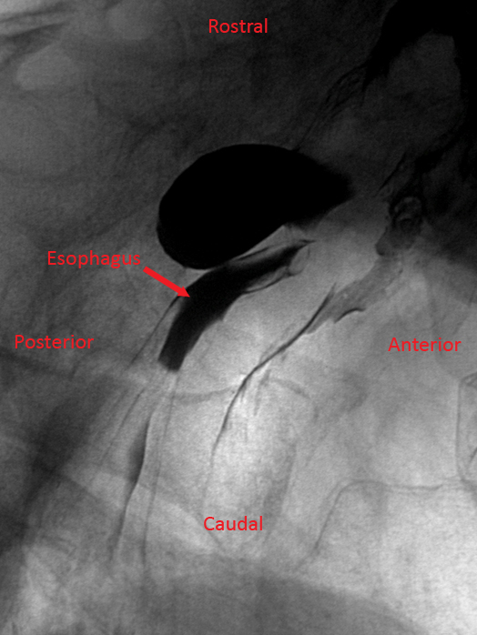 A 74-year-old man comes to the office due to several months of choking spells, dysphagia, and cough.  He has also had recurrent episodes of pneumonia.  His other medical problems include hypertension and osteoarthritis.  Blood pressure is 130/70 mm Hg.  The patient has foul-smelling breath, but his oropharyngeal and neck examinations are normal.  Cardiopulmonary examination is also normal.  A barium swallow study is performed and reveals an abnormality in the upper esophagus, as shown in the image below.   Which of the following mechanisms is the most likely cause of his symptoms? A) Cricopharyngeal motor dysfunction B) Degenerative changes of the myenteric plexus C) Increased intraluminal pressure in the stomach D) Retention cyst due to duct obstruction E) Scarring and traction of the esophagus