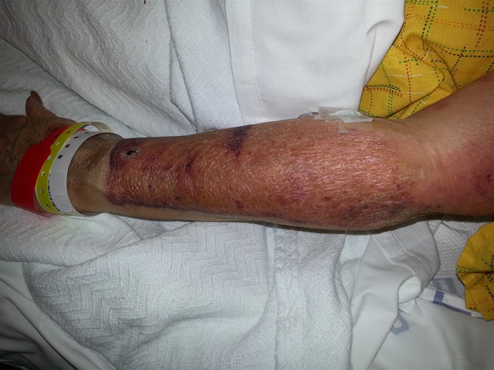 A 50-year-old woman comes to the emergency department due to a large, painful skin lesion.  She does not remember sustaining any trauma.  She was recently diagnosed with atrial fibrillation and started on treatment with warfarin.  The patient noticed the lesion about a day and a half after starting the medication.  Temperature is 36.7 C (98 F) , blood pressure is 130/82 mm Hg, and pulse is 88/min and irregularly irregular.  Physical examination findings are shown in the image below.   The remainder of the skin examination is normal.  Which of the following is the most likely cause of this patient's skin lesion? A) Allergic drug reaction B) Antithrombin deficiency C) Autoimmune phenomena D) Protein C deficiency E) Vitamin K deficiency