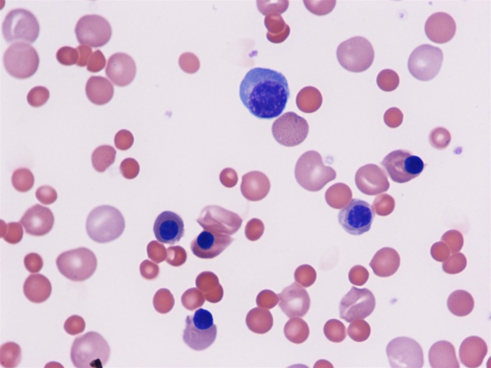 A 32-year-old woman comes to the office due to worsening fatigue and exercise intolerance.  She has no history of blood disorders.  Physical examination shows mild mucosal pallor.  Hemoglobin is 7.8 g/dL.  Peripheral blood smear is shown in the image below.   Which of the following is the most likely cause of this patient's anemia? A) Erythropoietin deficiency B) Hemolytic anemia C) Iron deficiency anemia D) Thrombotic microangiopathy E) Vitamin B<sub>12</sub> deficiency