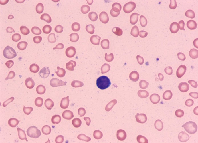 A 19-year-old woman comes to the office due to exertional dyspnea and intermittent lightheadedness.  On examination, mucosal pallor is present.  Laboratory studies reveal a red blood cell count of 3.5 million/mm<sup>3</sup> and a hemoglobin concentration of 8.5 g/dL.  Peripheral smear is shown in the image below:   Which of the following findings are most likely present in this patient? A) Decreased transferrin binding capacity B) Increased macrophage iron retention C) Increased serum cytokine levels D) Increased serum erythropoietin levels E) Increased serum hepcidin levels