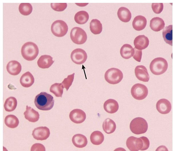 A 26-year-old woman comes to the office for a follow-up appointment.  She has a history of immune thrombocytopenia that failed to improve with glucocorticoid therapy.  The patient underwent splenectomy 6 months ago, which resulted in improved platelet counts.  She received the recommended vaccinations after her surgery and currently feels well.  Physical examination shows no abnormalities.  A peripheral blood smear reveals many red blood cells of a specific morphology as indicated by the arrow below.   An increase in which of the following features best explains the presence of these abnormal cells? A) Aggregated iron deposits B) Clusters of remnant DNA C) Denatured hemoglobin D) Fragility to osmotic stress E) Precipitated ribosomes F) Surface area-to-volume ratio