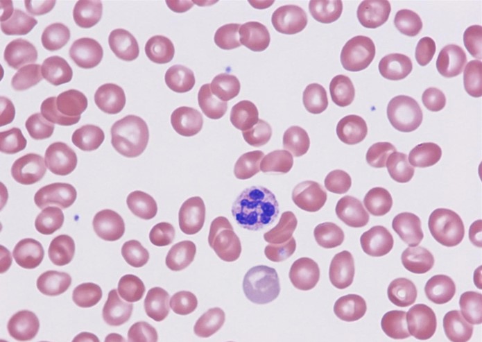 A 65-year-old man comes to the office due to a few weeks of progressive exertional dyspnea and fatigue.  He has had no chest pain, fever, or cough.  The patient has a history of mild aortic stenosis, gastroesophageal reflux disease, obesity, hypertension, and hypercholesterolemia.  Temperature is 36.7 C (98 F) , blood pressure is 130/78 mm Hg, pulse is 82/min, and respirations are 16/min.  BMI is 28 kg/m<sup>2</sup>.  Pulse oximetry shows 96% on room air.  Mucosal pallor is present, but there is no jaundice, lymphadenopathy, or jugular venous distension.  Cardiopulmonary examination reveals a 2/6 systolic ejection murmur at the second right intercostal area.  The abdomen is soft and nontender; there is no palpable hepatosplenomegaly.  Peripheral pulses are normal.  Laboratory results are as follows:   Peripheral blood smear is shown below:   Which of the following is most likely responsible for this patient's current condition? A) Impaired DNA synthesis B) Impaired heme production C) Inadequate erythropoietin production D) Replacement of bone marrow with fat cells E) Replacement of bone marrow with fibrosis F) Traumatic hemolysis