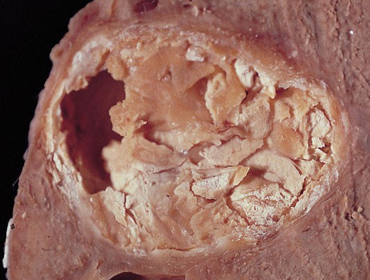 A 37-year-old woman comes to the office due to right-sided abdominal discomfort that has been getting progressively worse over the past few weeks.  She has not had any nausea or vomiting.  The patient's family moved to the United States from rural Kazakhstan when she was a child.  The patient has no drug allergies.  She does not use tobacco or alcohol.  She has a dog at home.  Temperature is 36.7 C (98.1 F) .  Physical examination is notable for hepatomegaly.  Ultrasound reveals a large liver mass with cystic lesions.  During surgery to resect the mass, the patient suffers from a procedural complication and dies.  At the family's request, an autopsy is performed.  A cut section of a portion of the mass is shown in the image below.   Which of the following is the most likely cause of this patient's death? A) Anaphylaxis B) Fulminant liver failure C) Hypovolemia D) Pulmonary embolism E) Septic shock