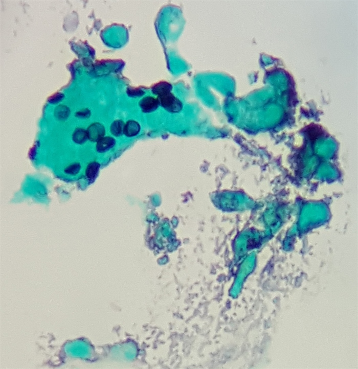 A 48-year-old homeless man is brought to the emergency department after being found unresponsive on the sidewalk.  Medical history is unknown.  Temperature is 38.3 C (101 F) , blood pressure is 116/70 mm Hg, pulse is 108/min, and respirations are 26/min.  Oxygen saturation is 88% on 100% oxygen via face mask.  The patient is ill-appearing, thin, and disheveled with poor dentition.  There are a few white patches on the oral mucosa, but no skin rash is present.  Lung auscultation reveals bilateral crackles.  There are healed abdominal scars from a previous surgery.  The abdomen is soft with no hepatomegaly or splenomegaly.  Chest x-ray reveals bilateral interstitial infiltrates.  A silver-stained bronchoalveolar lavage specimen is shown in the image.   Which of the following most likely predisposed this patient to his current lung condition? A) Aspiration of oropharyngeal secretion B) Decreased mucociliary clearance C) Defective antibody-specific response D) Impaired cell-mediated immunity E) Postsplenectomy state
