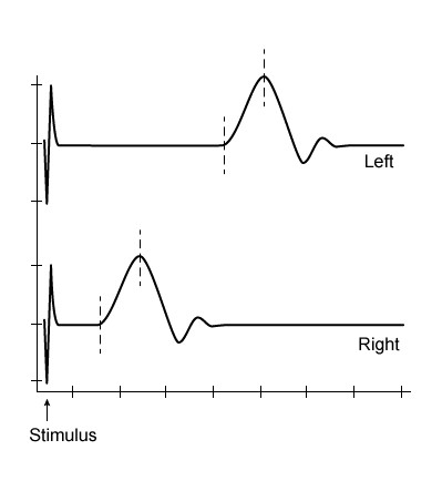 A 38-year-old woman is being evaluated for intermittent tingling and numbness of the left hand for the past several months.  Her symptoms predominantly involve the fourth and fifth digits and are often brought on by driving a car.  Physical examination shows no abnormalities.  An electrodiagnostic study is performed, during which a nerve stimulator is placed on the left fifth digit and a surface recorder is placed over the ulnar nerve above the elbow.  Electrical stimulus is applied, and the graph obtained is shown below.  Results from the asymptomatic contralateral extremity are also shown.  Which of the following is primarily affected in this patient?   A) Neuronal axons B) Neuronal cell bodies C) Postsynaptic membrane D) Schwann cells E) Synaptic vesicles